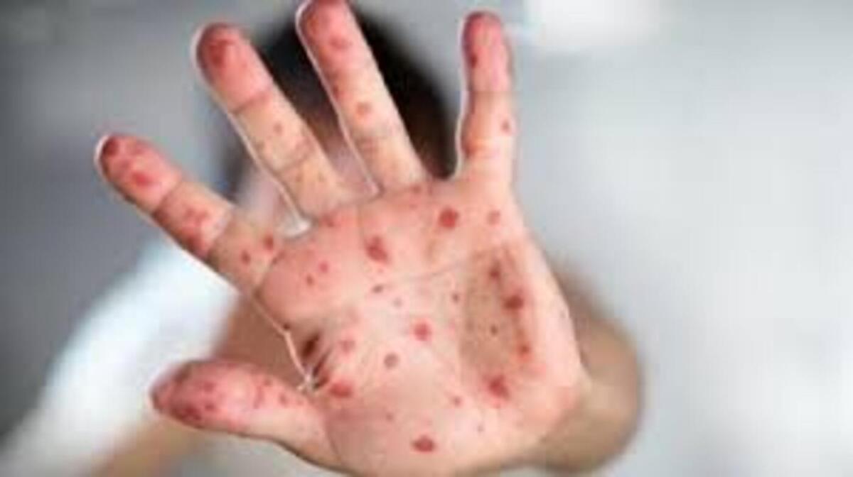 Waspadai Upal dan Sebaran Campak